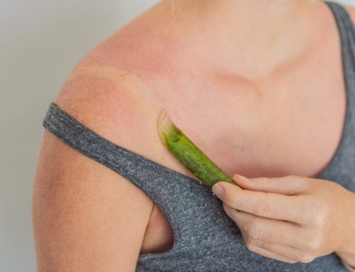 Natural Ways to Soothe Summer Sunburns